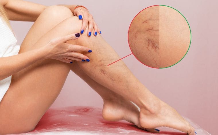spider vein removal